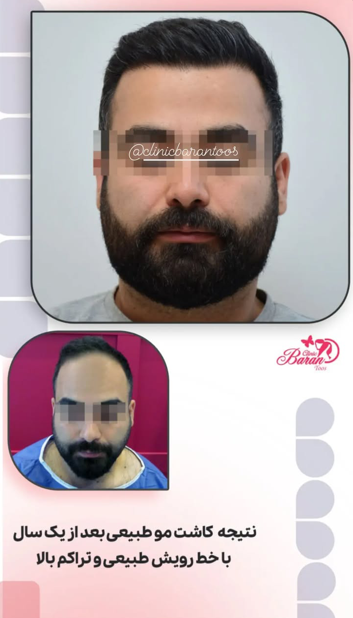 قبل و بعد کاشت مو با خط رویش طبیعی و استاندارد 2